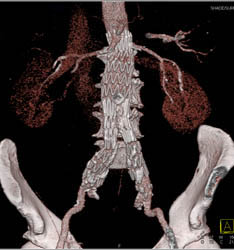 Stent in Aorta and Iliac Arteries With Vessel Tracking - CTisus CT Scan