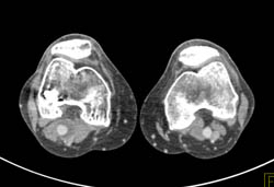 Right Popliteal Artery Aneurysm - CTisus CT Scan