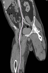 Vascular Mapping of Aorta and Iliac Arteries - CTisus CT Scan