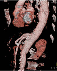 Ductus Aneurysm - CTisus CT Scan