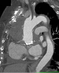 Post Repair of Ascending Aorta - CTisus CT Scan