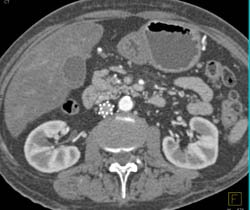 Inferior Vena Cava (IVC) Filter - CTisus CT Scan