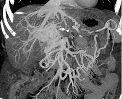 Portal Vein Thrombosis (PVT) With Collaterals - CTisus CT Scan