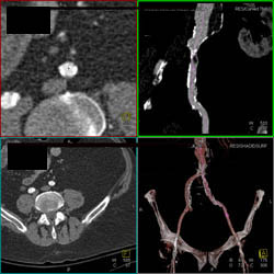 Tracing of Iliac Disease - CTisus CT Scan