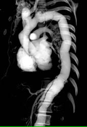 Fibrosis Around Ascending Aorta Similar to Retroperitoneal Fibrosis - CTisus CT Scan