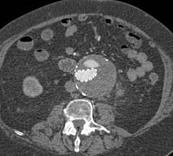 Large Endoleak - CTisus CT Scan