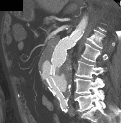 Endovascular Stent Failure With Endoleak - CTisus CT Scan