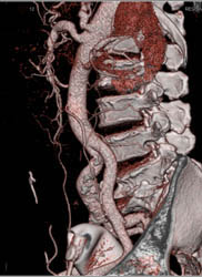 Iliac Artery Aneurysm - CTisus CT Scan