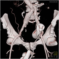 Iliac Artery Aneurysm - CTisus CT Scan