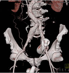 Iliac Artery Aneurysm - CTisus CT Scan