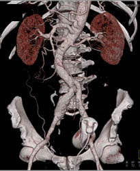 Iliac Artery Aneurysm - CTisus CT Scan