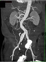 Iliac Artery Aneurysm - CTisus CT Scan