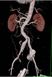 Iliac Artery Aneurysm - CTisus CT Scan