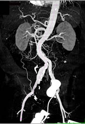 Iliac Artery Aneurysm - CTisus CT Scan