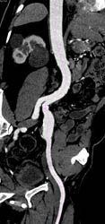 Iliac Artery Aneurysm - CTisus CT Scan