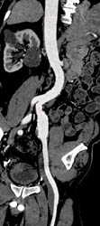 Iliac Artery Aneurysm - CTisus CT Scan