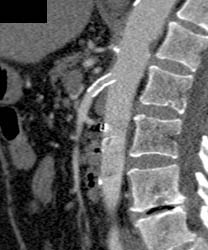 Patent SMA Stent - CTisus CT Scan