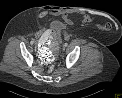 Coiled Arteriovenous Malformation (AVM) Is Still Patent - CTisus CT Scan