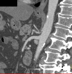 Median Arcuate Ligament Syndrome With Celiac Stenosis - CTisus CT Scan