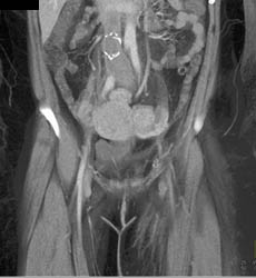 Iv Clot and Bleed - CTisus CT Scan