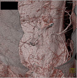 Will Replace - CTisus CT Scan