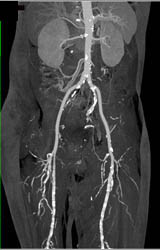 Runoff Study With Diseased SFA and Trifurcation Vessels - CTisus CT Scan