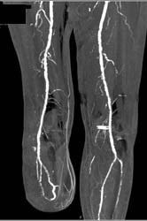 Diseased SFA With Amputation - CTisus CT Scan