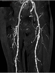 Diseased Superficial Femoral Arteries (SFAs) - CTisus CT Scan