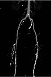 Diseased Superficial Femoral Arteries (SFAs) - CTisus CT Scan