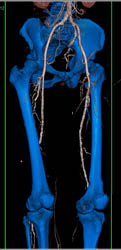 Superficial Femoral Artery (SFA) Occlusion - CTisus CT Scan