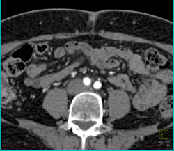 Iliac Artery Occlusion on Right - CTisus CT Scan