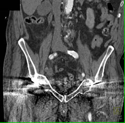 Iliac Dissection on Right - CTisus CT Scan