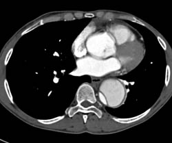 Type B Dissection - CTisus CT Scan