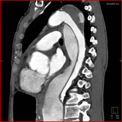 Type B Dissection - CTisus CT Scan