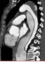 Type B Dissection - CTisus CT Scan