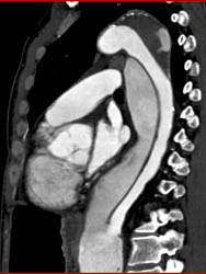 Type B Dissection - CTisus CT Scan