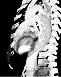 Type B Dissection - CTisus CT Scan