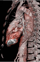 Type B Dissection - CTisus CT Scan