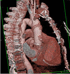 Avascular Necrosis (AVN) Replacement - CTisus CT Scan