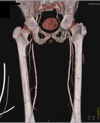 CTA With Peripheral Vascular Disease (PVD) - CTisus CT Scan