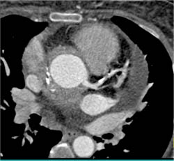 Inflammatory Changes in Aortic Root - CTisus CT Scan