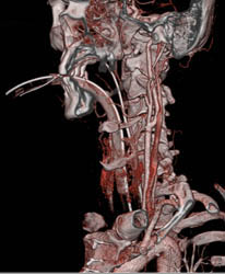 Carotid Bifurcation - CTisus CT Scan