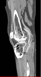 Popliteal Artery Aneurysm - CTisus CT Scan