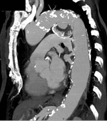 Ductus Aneurysm - CTisus CT Scan