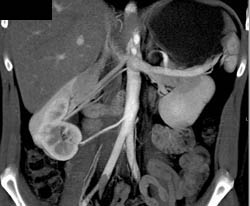 3 Right Renal Arteries - CTisus CT Scan