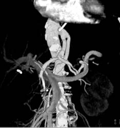 Mesenteric Vascular Bypass Grafts - CTisus CT Scan