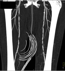 Peripheral Vascular Disease (PVD) in SFAs - CTisus CT Scan