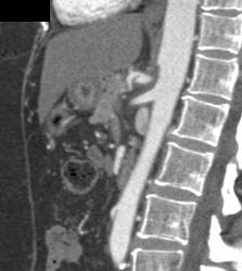 Median Arcuate Ligament Syndrome - CTisus CT Scan