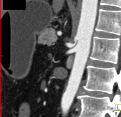 Median Arcuate Ligament Syndrome - CTisus CT Scan