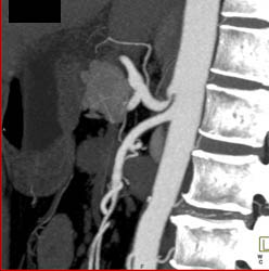 Median Arcuate Ligament Syndrome - CTisus CT Scan